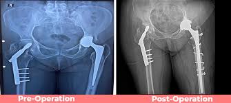Hip Replacement Surgery in Kabirdham