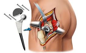 Hip Replacement Surgery in Kanker