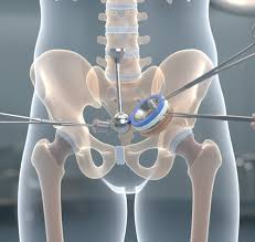 Hip Replacement Surgery in Kondagaon