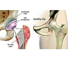 Hip Replacement Surgery in Manendragarh-Chirmiri-Bharatpur