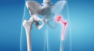 Hip Replacement Surgery in Mungeli