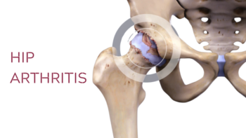 Hip arthritis solutions