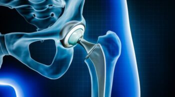 Hip joint function improvement