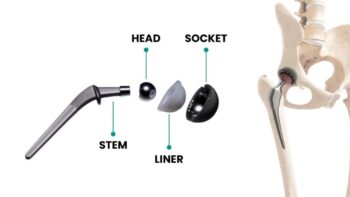 Hip prosthetic implant