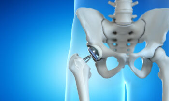 Hip replacement benefits