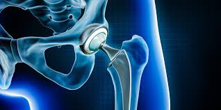 Hip replacement surgery in Gwalior