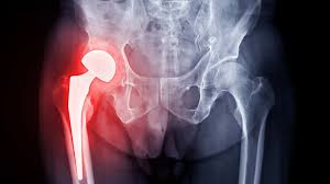 Hip replacement surgery in Katni