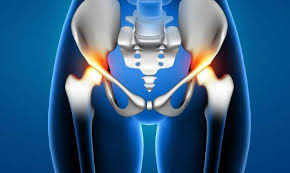 Hip replacement surgery in Mandsaur