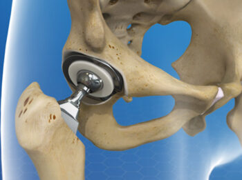 Hip replacement surgery in yavatmal
