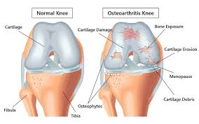 Joint Pain Treatment in Koriya