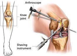Knee Arthroscopy In Nagpur