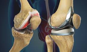 Knee Replacement Surgery In Bhind