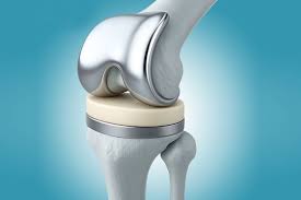 Knee Replacement Surgery In Mandsaur