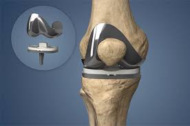 Knee Replacement Surgery In Shivpuri
