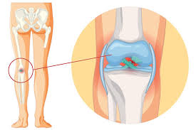 Knee Replacement Surgery In Ujjain