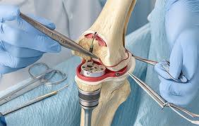 Knee Replacement Surgery in Bemetara