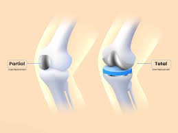 Knee Replacement Surgery in Durg