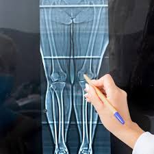 Knee Replacement Surgery in Gariaband