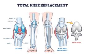 Knee Replacement Surgery in Indore
