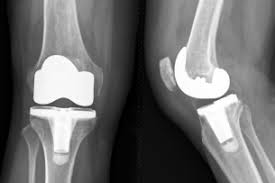 Knee Replacement Surgery in Kabirdham