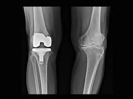 Knee Replacement Surgery in Kanker