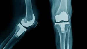 Knee Replacement Surgery in Korba