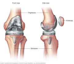 Knee Replacement Surgery in Mahasamund