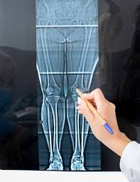 Knee Replacement Surgery in Mohla‑Manpur‑Ambagarh Chowki