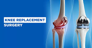 Knee replacement surgery in Gwalior