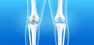 Knee replacement surgery in Katni