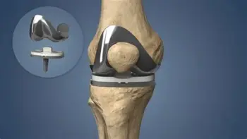 Knee replacement surgery in akola