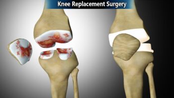 Knee replacement surgery in chandrapur