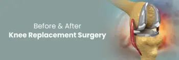 Knee replacement surgery in wardha