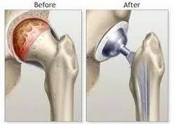 Limb Salvage Surgery in Nagpur