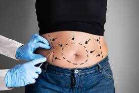 Liposuction In Guna