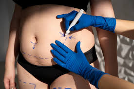 Liposuction In Ratlam