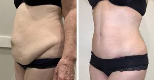 Liposuction In Shivpuri
