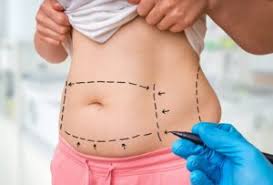 Liposuction in Bilaspur