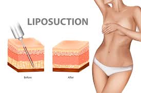 Liposuction in Kanker