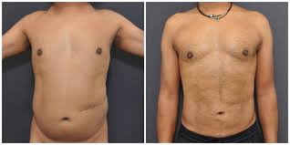 Liposuction in Katni