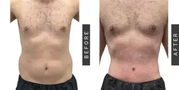 Liposuction in amravati