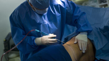 Liposuction in chandrapur