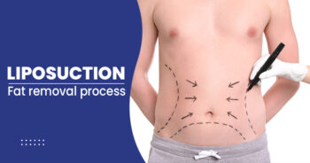 Liposuction in gondia