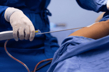 Liposuction in wardha