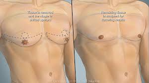 Male Breast Reduction in Nagpur