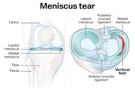 Meniscus Tear Repair in Nagpur