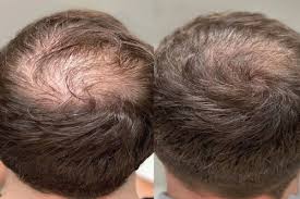 PRP Hair Treatment in Nagpur