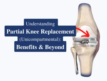 Partial-Knee-Replacement