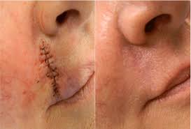 Post-Surgical Scar Treatment in Nagpur