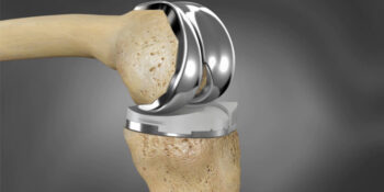 Precision implant alignment